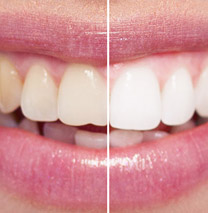 Zoom! Teeth Whitening